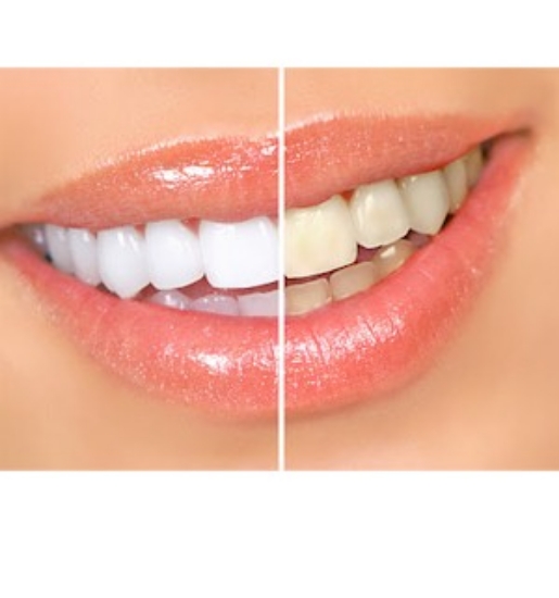 Recommended by dentists, This is an effective, affordable, 100% safe, and completely painless teeth whitening system. 
<br /><br />

This system is similar to over-the-counter products but the difference is the FDA-Approved LED light to expedite the bleaching and whitening process.