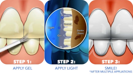 Recommended by dentists, This is an effective, affordable, 100% safe, and completely painless teeth whitening system. 
<br /><br />

This system is similar to over-the-counter products but the difference is the FDA-Approved LED light to expedite the bleaching and whitening process.
