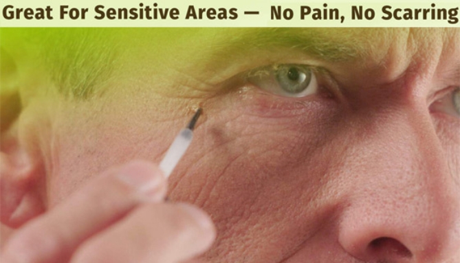 Picture 3 of ENDtag Skin Tag Remover