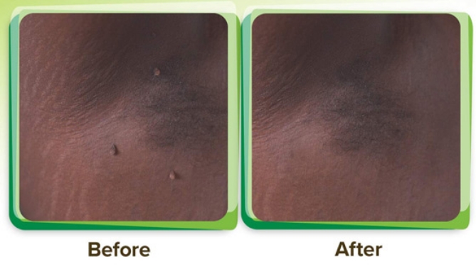 Picture 2 of ENDtag Skin Tag Remover - 3 Bottles