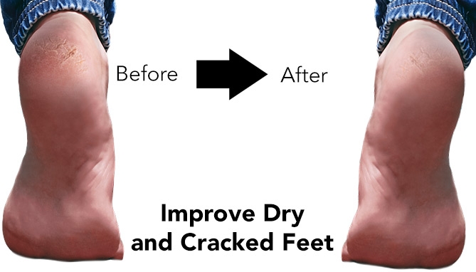 Picture 2 of Slip Resistant Silicone Moisturizing Socks for Dry, Cracked Feet